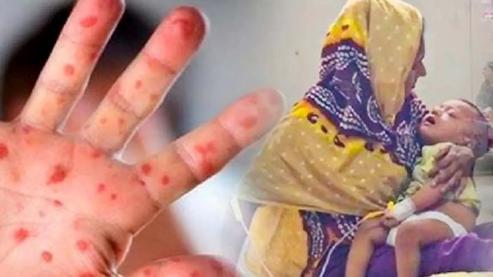 হামে ও উপসর্গে মৃত্যু বেড়ে ৬১০, ২৪ ঘণ্টায় প্রাণ গেল আরও ৫ শিশুর